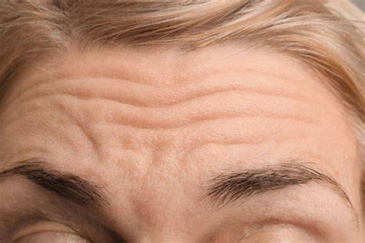 How do you treat forehead wrinkles?