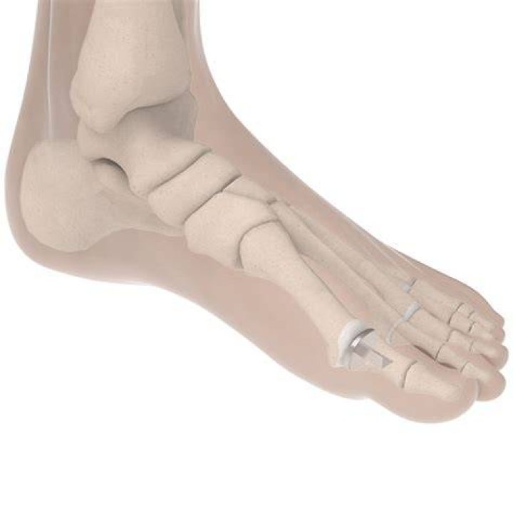 What is a toe implant?