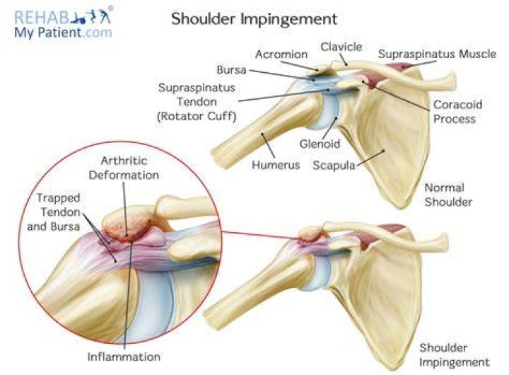 What is an impinged shoulder?